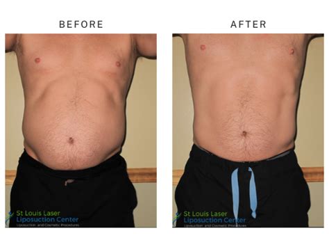 Top Liposuction Doctors in Saint Louis, MO